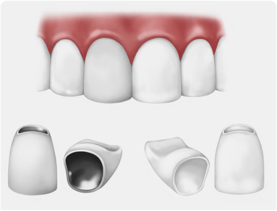 Jacket Crowns