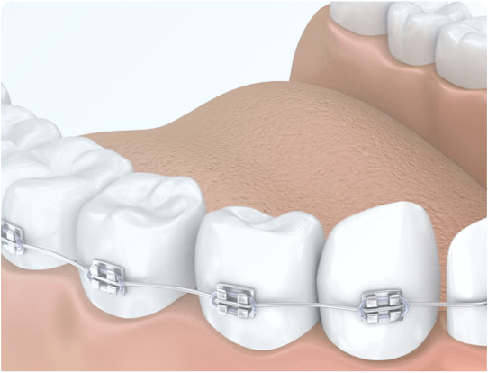 Teeth Straightening