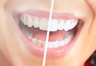 Teeth Whitening